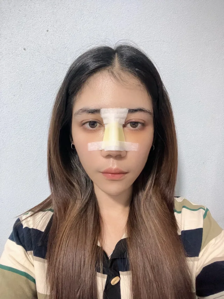 เสริมจมูกครั้งแรก