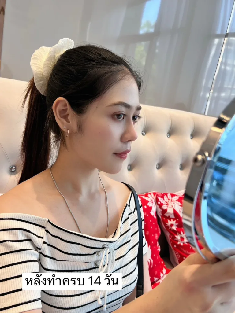 เสริมจมูกครั้งแรก