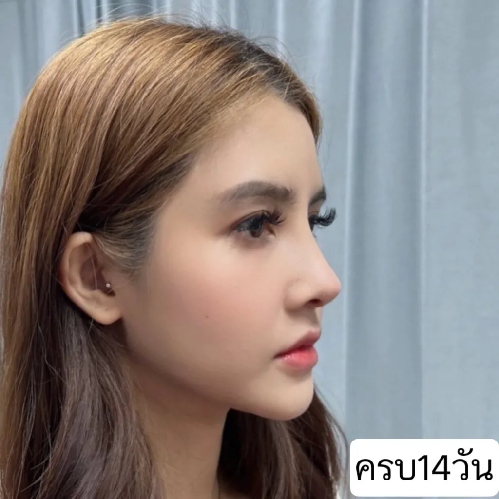 แก้จมูก