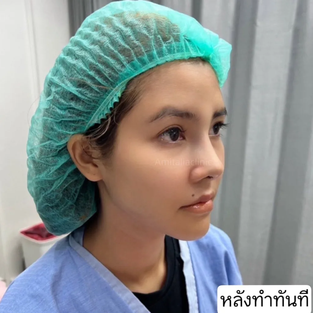 แก้จมูก