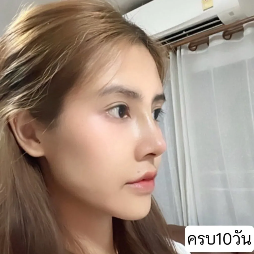 แก้จมูก