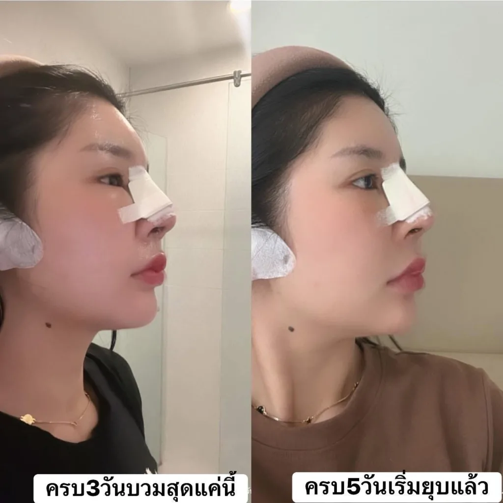รีวิวแก้จมูก