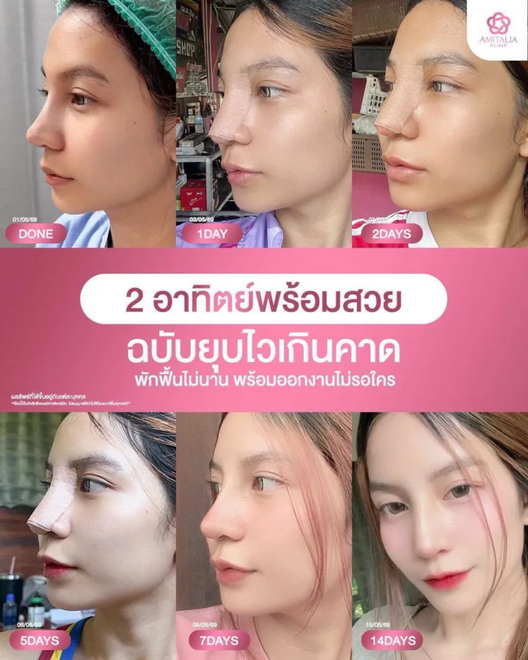 เสริมจมูกใหม่