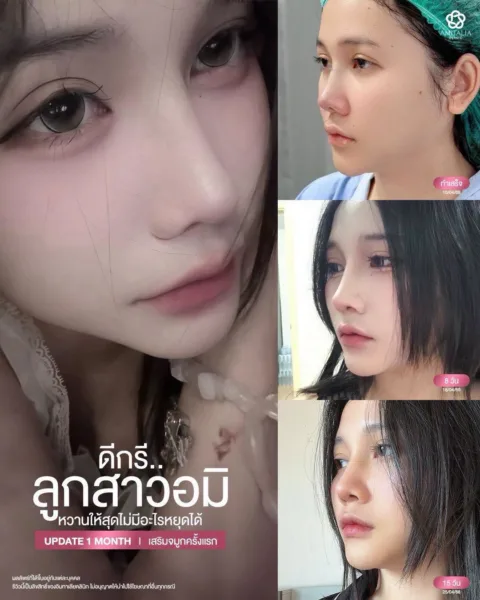 เสริมจมูกครั้งแรก