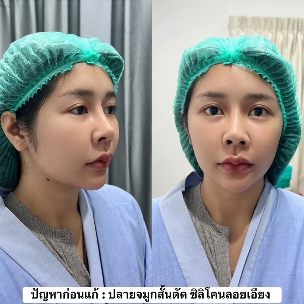 รีวิวแก้จมูก