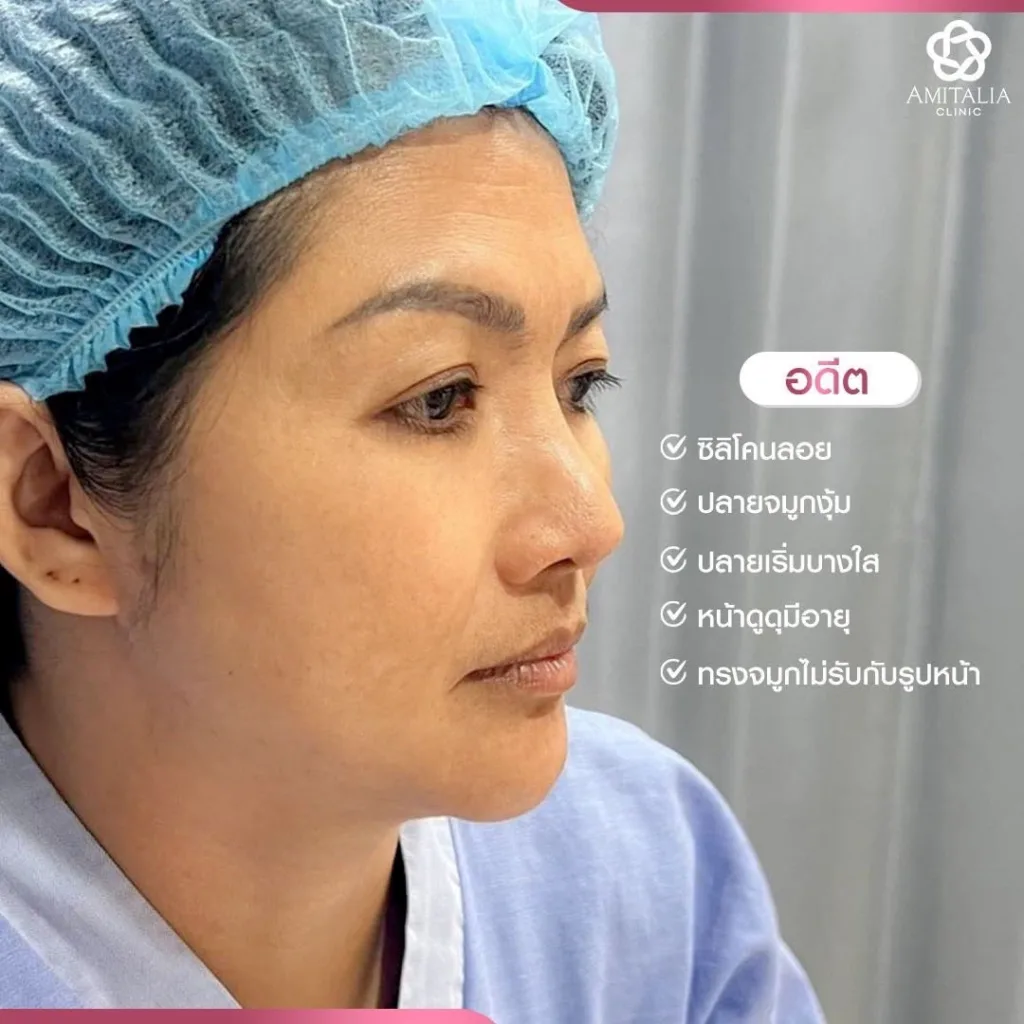 แก้จมูกใหม่