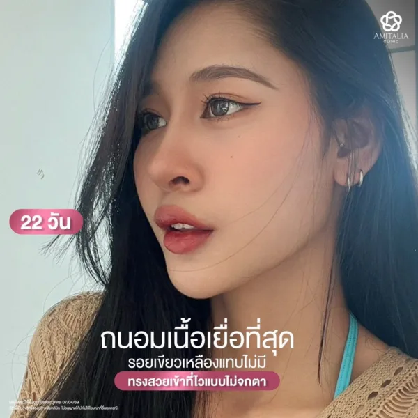 จมูกพัง