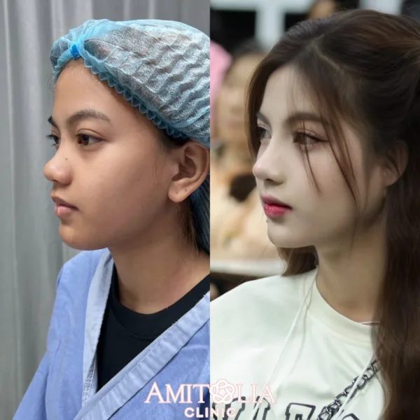 เสริมจมูกครั้งแรก