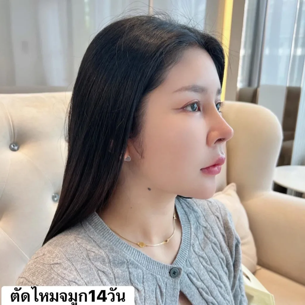 รีวิวแก้จมูก