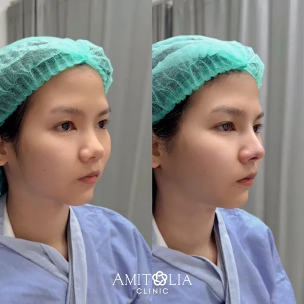 เสริมจมูก