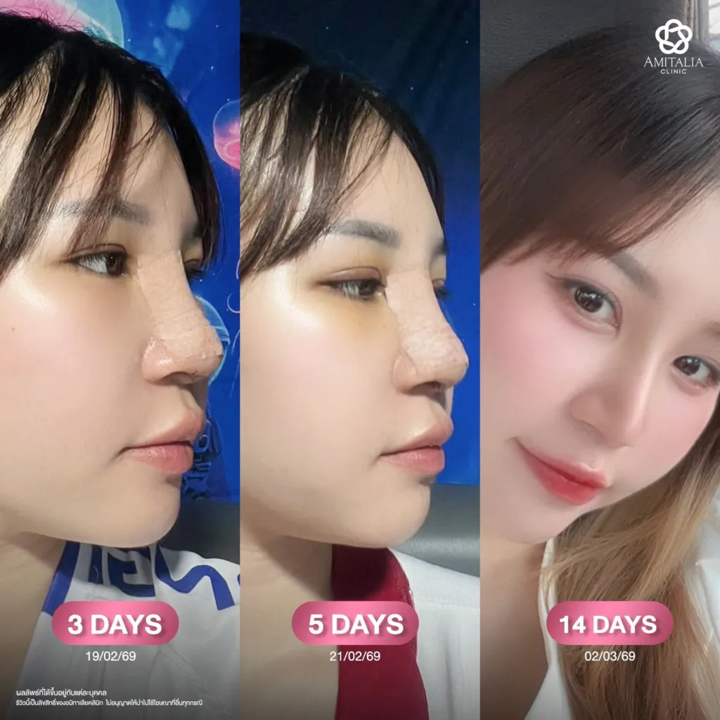 จมูกเก่า