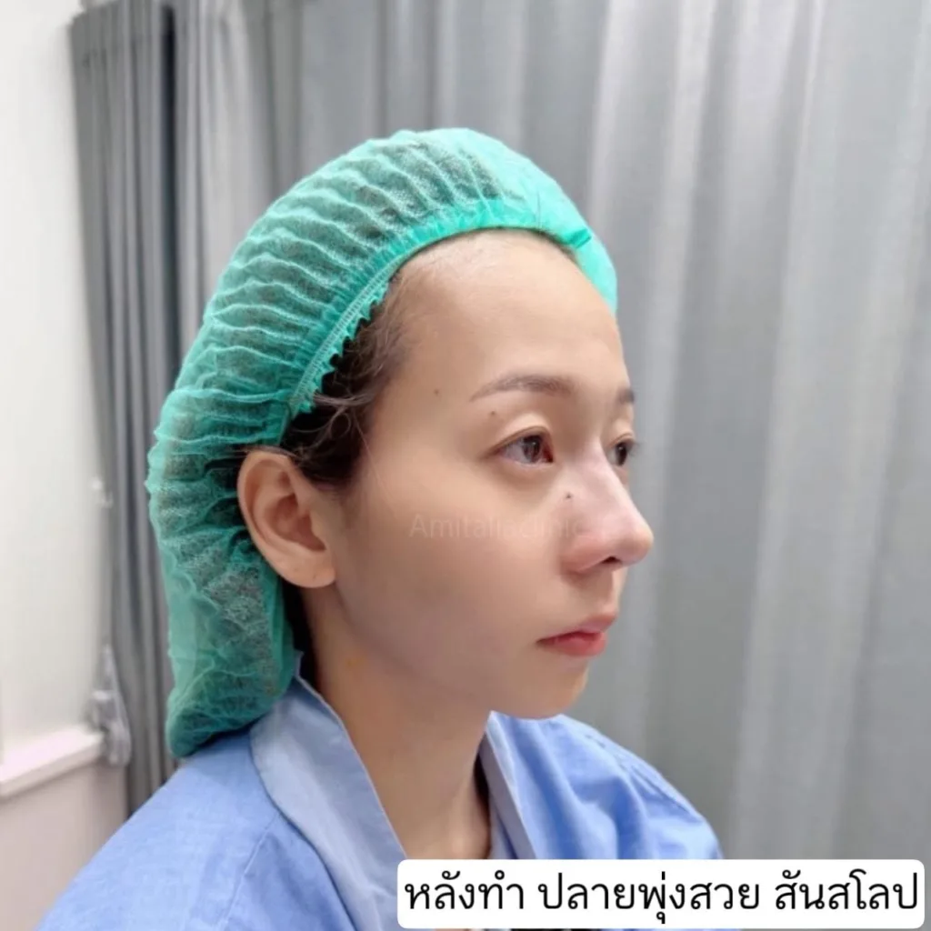 แก้ปัญหาจมูก