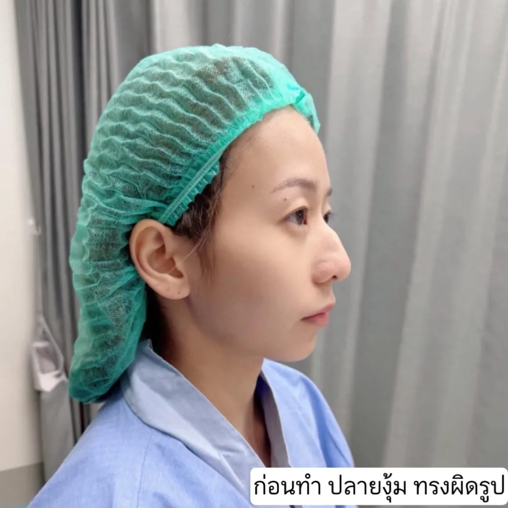 แก้ปัญหาจมูก
