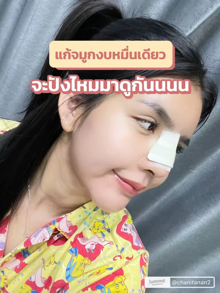 ศัลยกรรมแก้จมูก