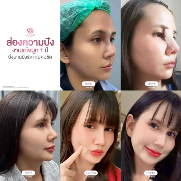 แก้จมูกครบ 1 ปี
