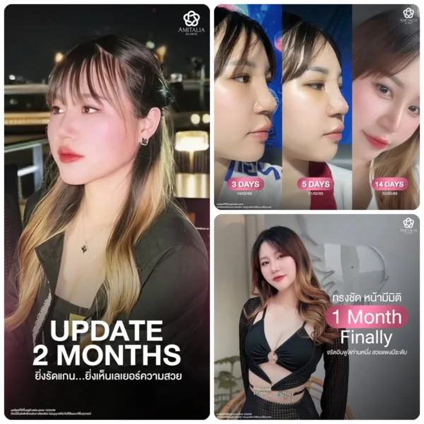 จมูกเก่า