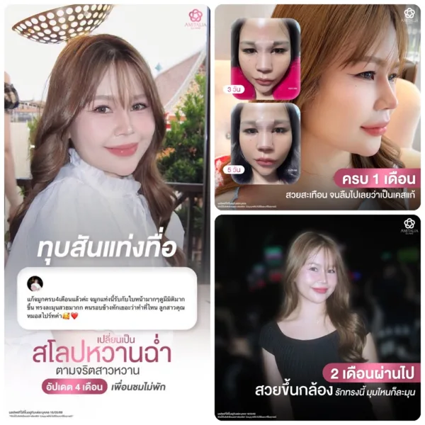 สันจมูก