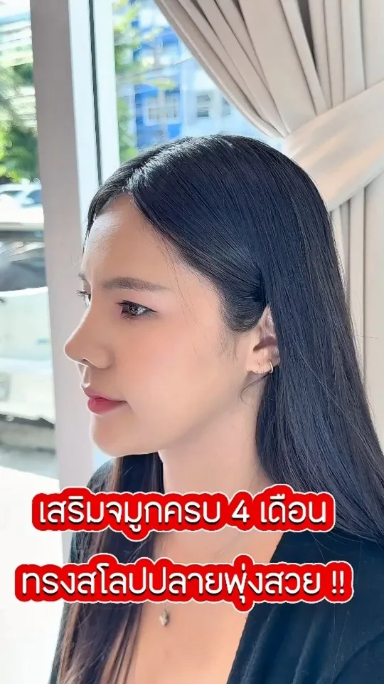 รีวิวเสริมจมูก