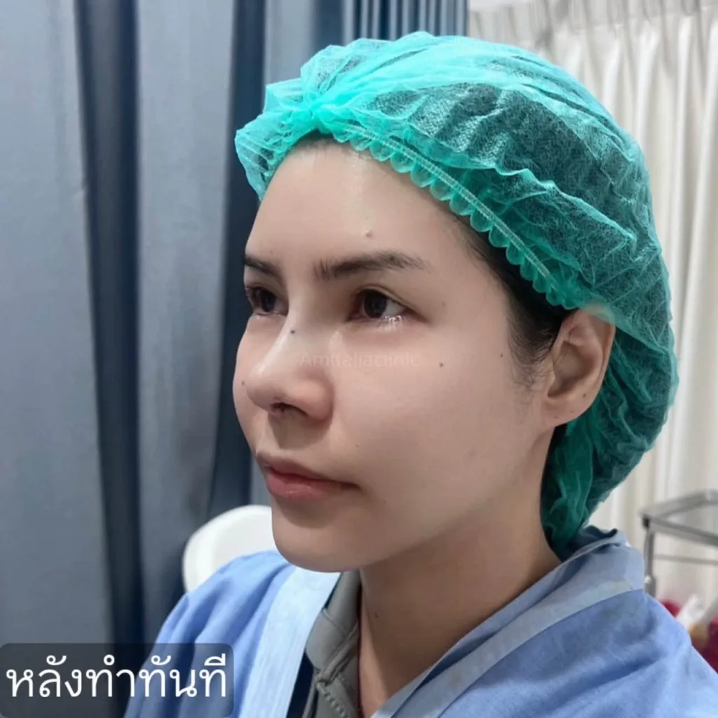 รีวิวแก้จมูก