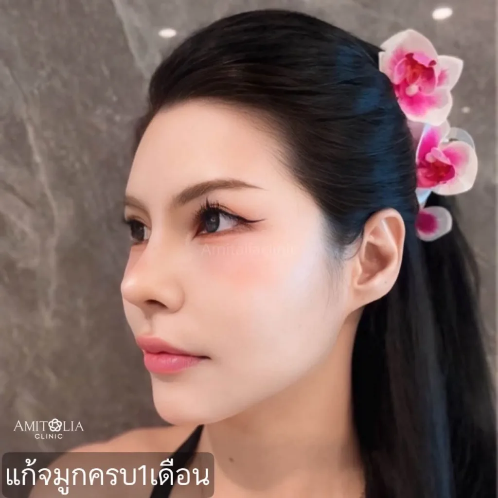 รีวิวแก้จมูก