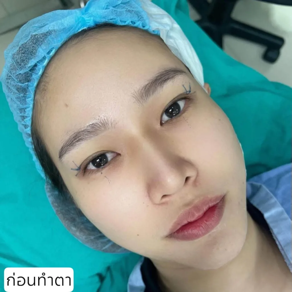 รีวิวแก้จมูก