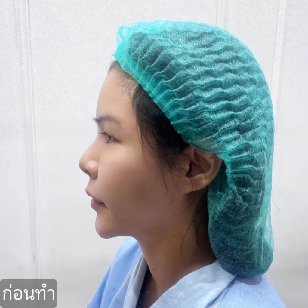 รีวิวแก้จมูก