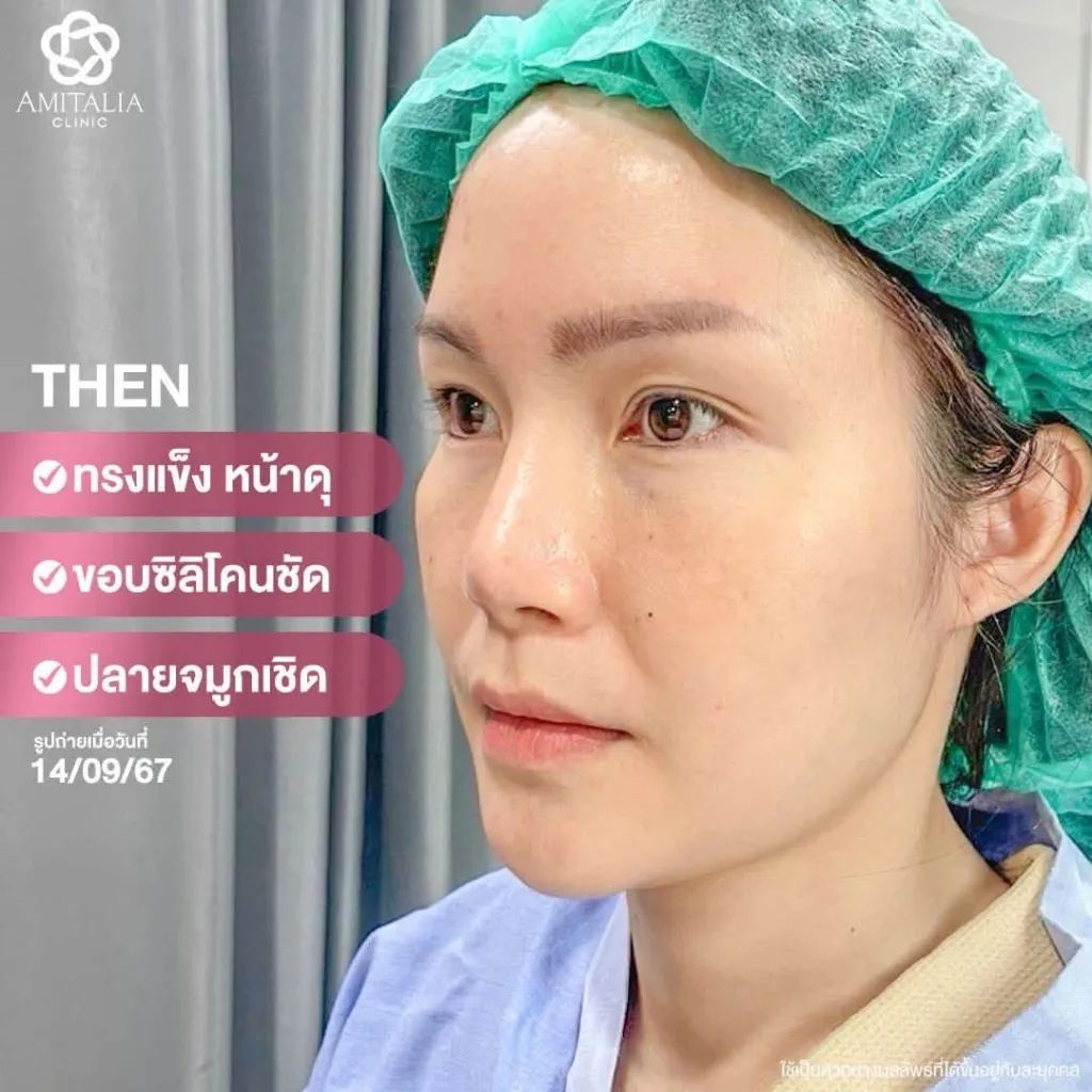 รีวิวแก้จมูก