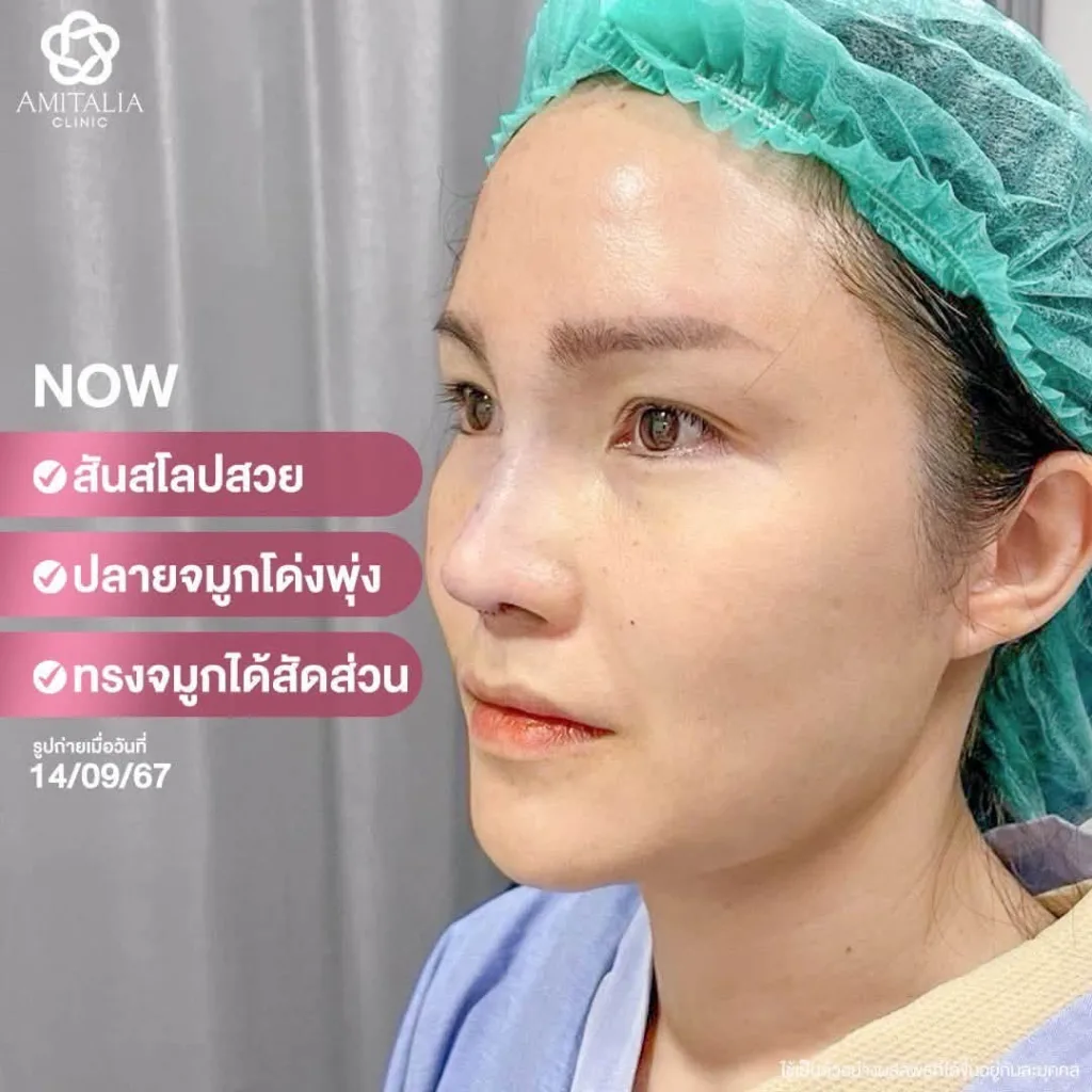 รีวิวแก้จมูก