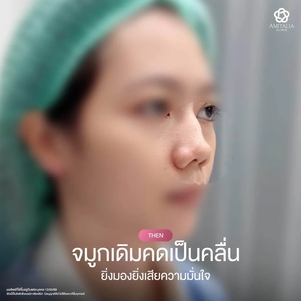 จมูกเดิมคด