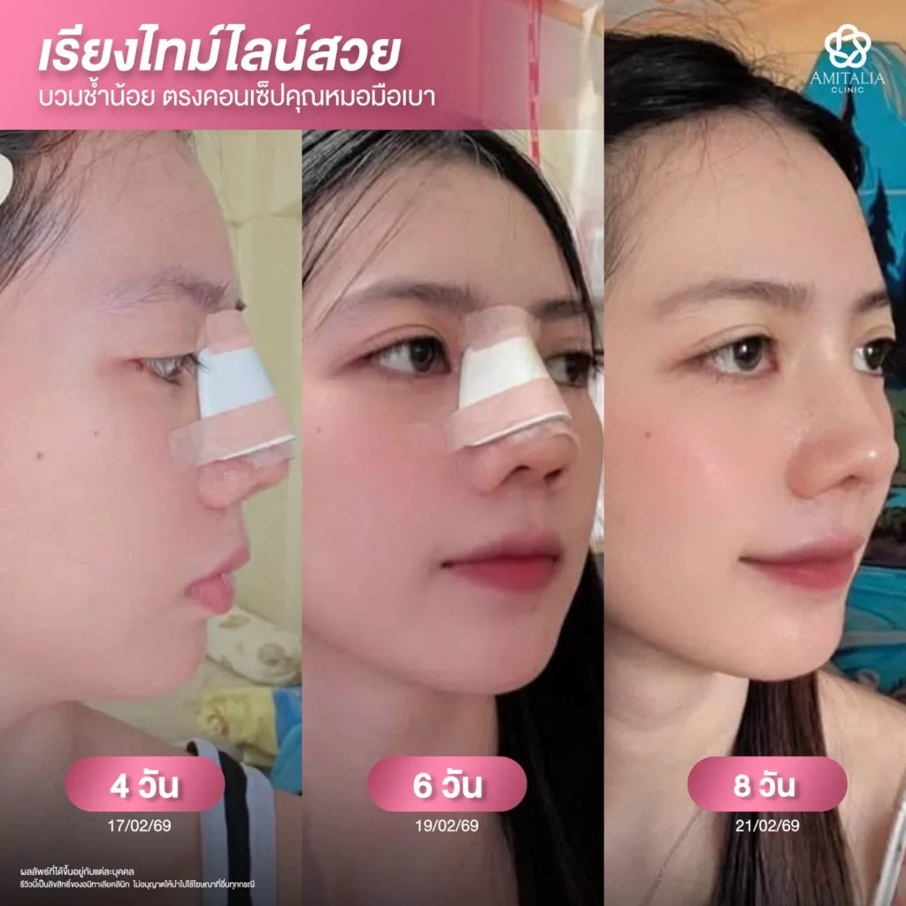 จมูกเดิมคด