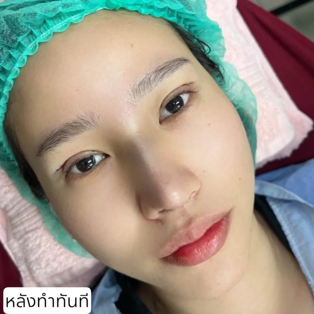 รีวิวแก้จมูก