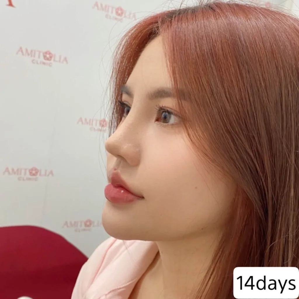 รีวิวทรงจมูก