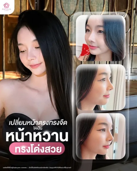 ศัลยกรรมจมูก