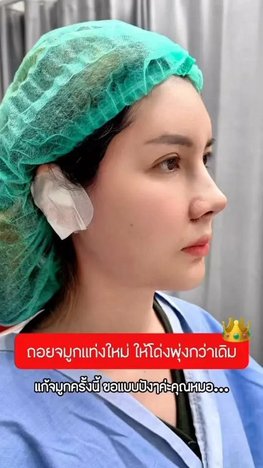 รีวิวแก้จมูก