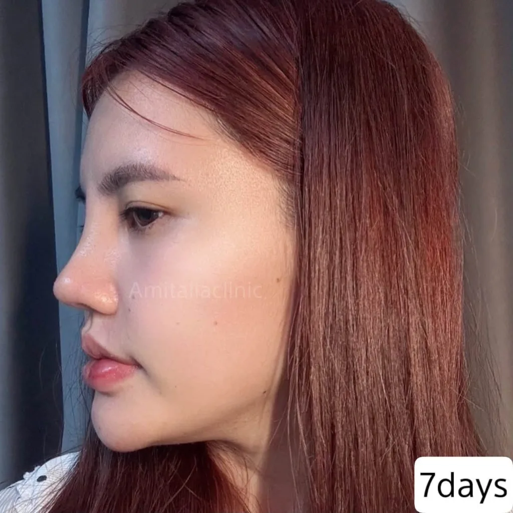 รีวิวทรงจมูก