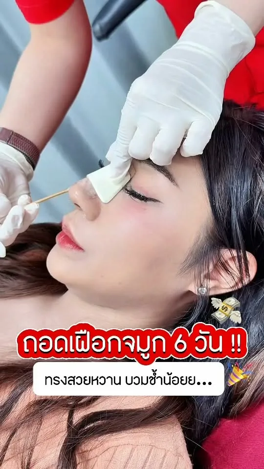 เสริมจมูกทรงโด่ง