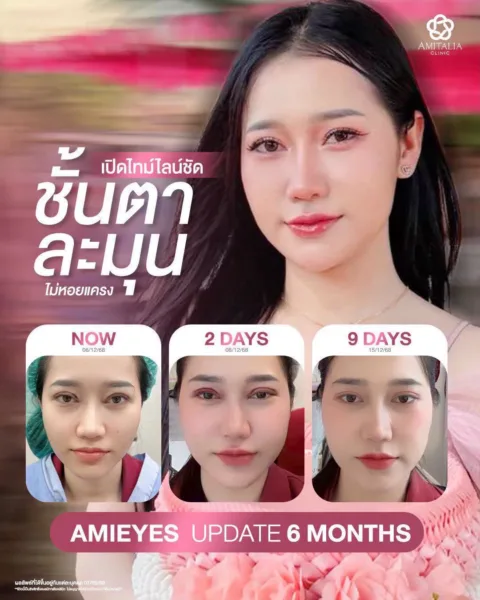 รีวิวทำตาสองชั้น