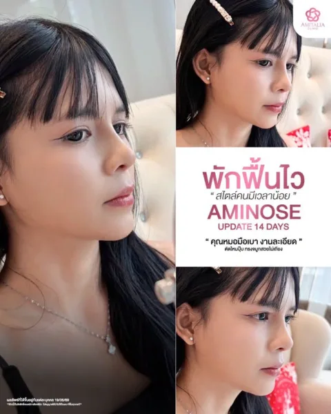 AMINOSE
