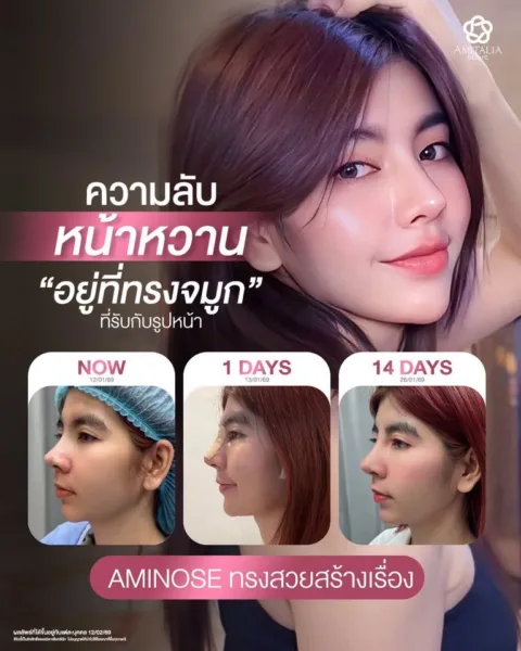 ทรงจมูก