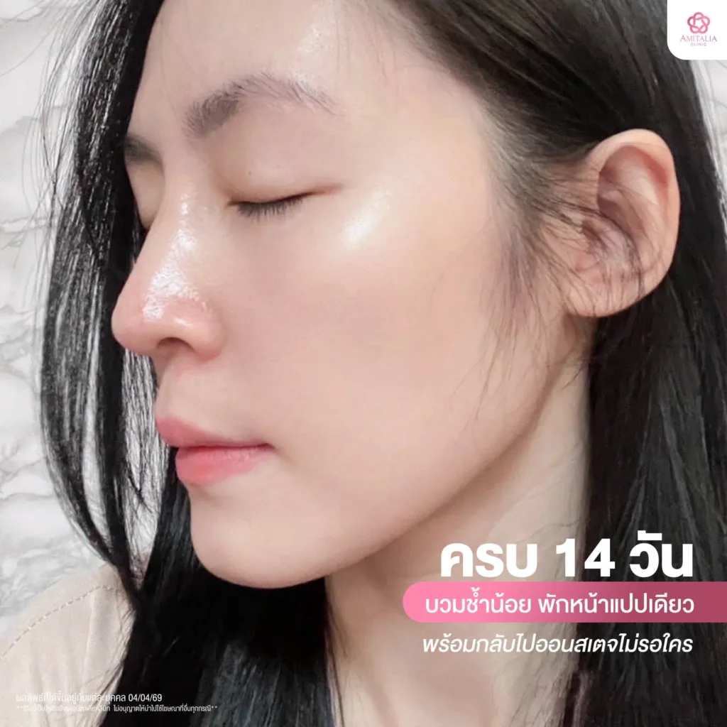 บวมช้ำ