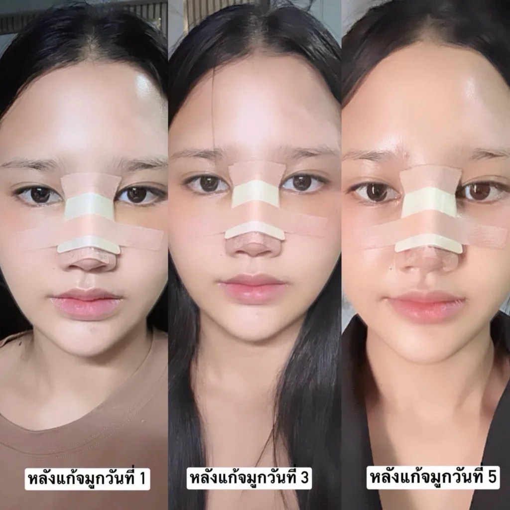 รีวิวทรงจมูก