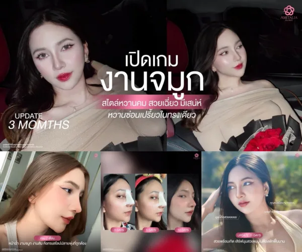 อัพเดทเสริมจมูก