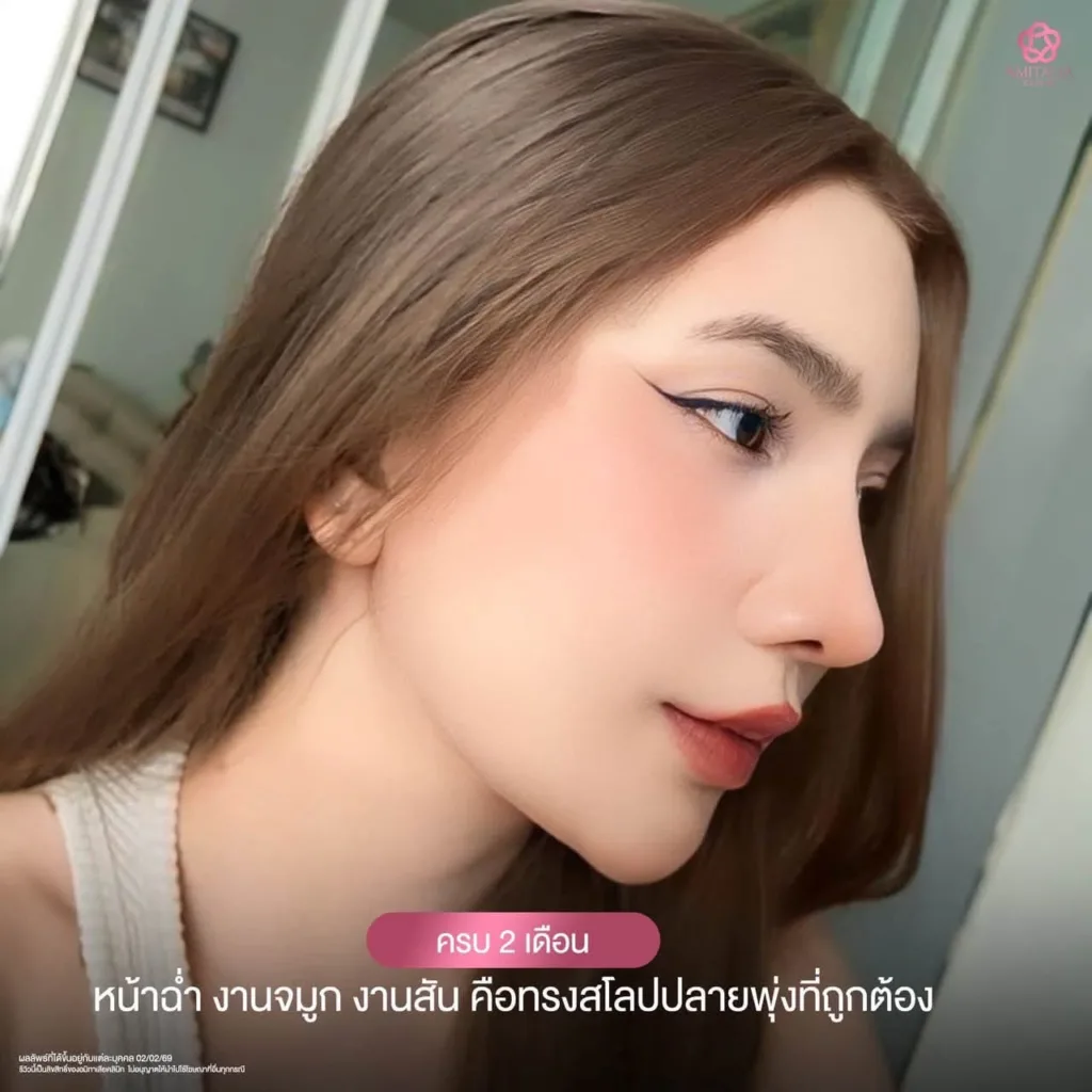 อัพเดทเสริมจมูก