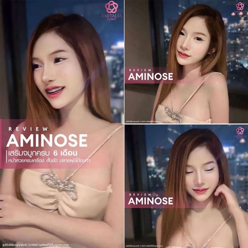 รีวิวเสริมจมูก
