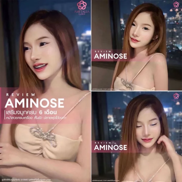 รีวิวเสริมจมูก