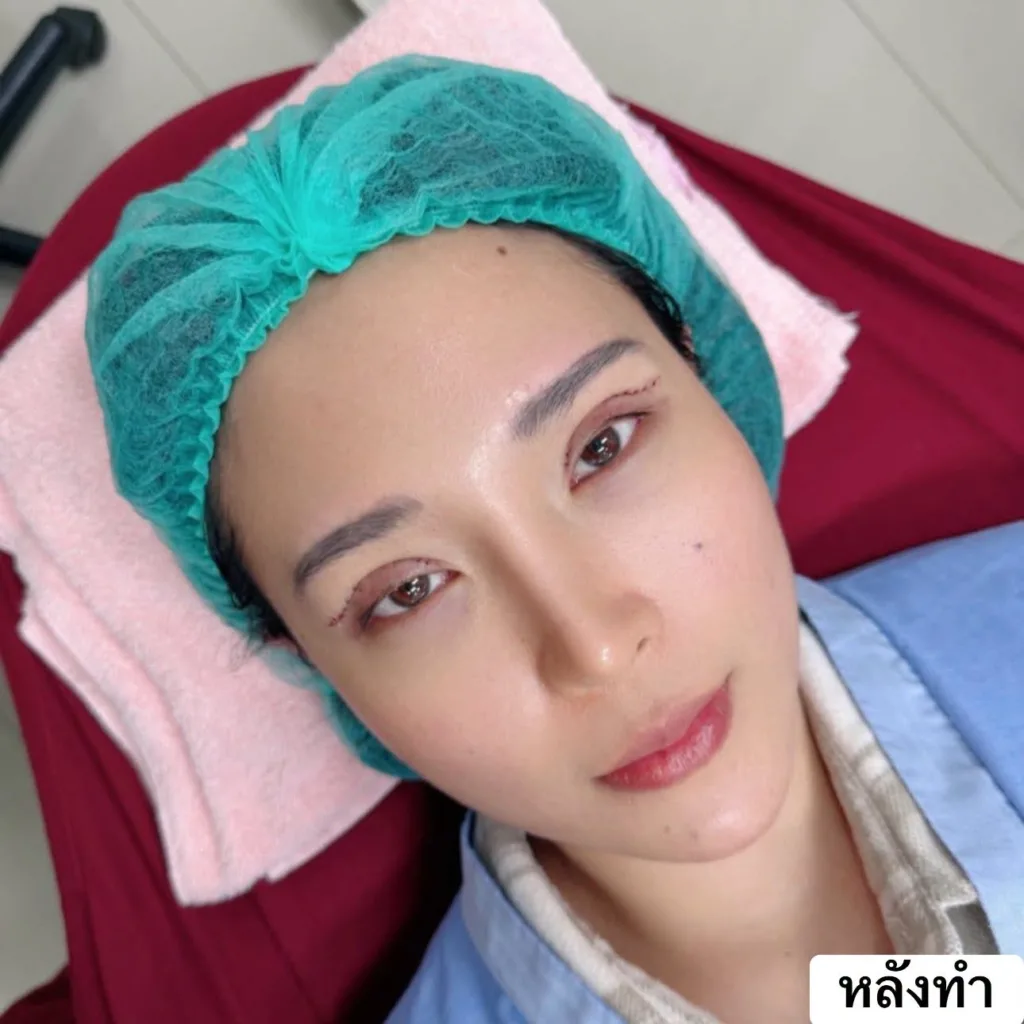 รีวิวทำตาสองชั้น