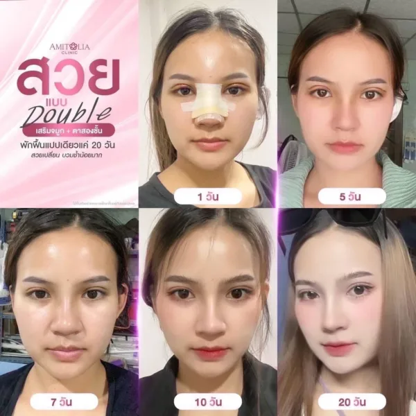 ศัลยกรรมเสริมจมูก