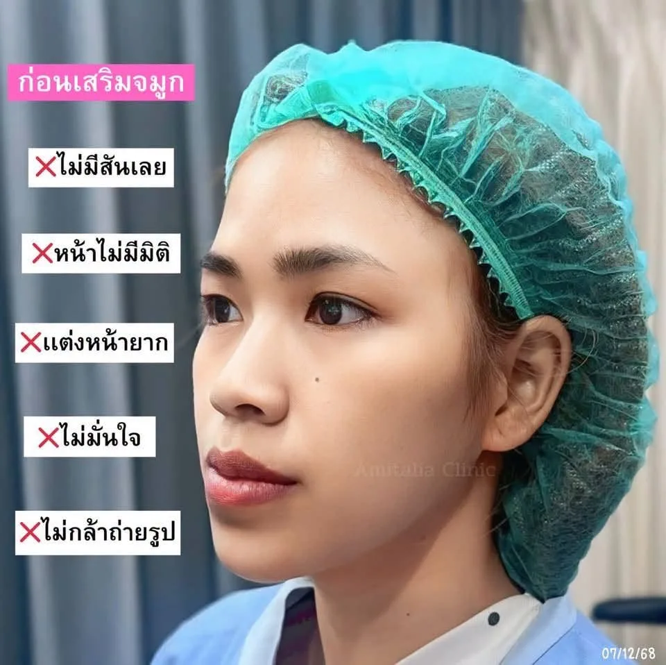 เสริมจมูกใหม่