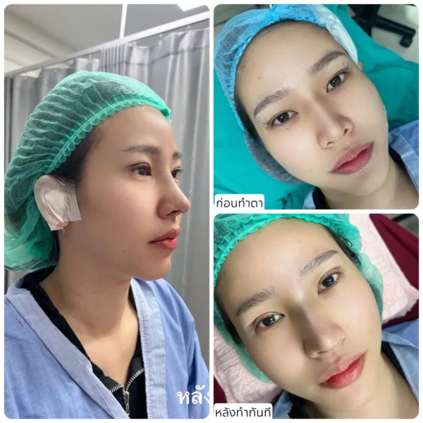 รีวิวแก้จมูก