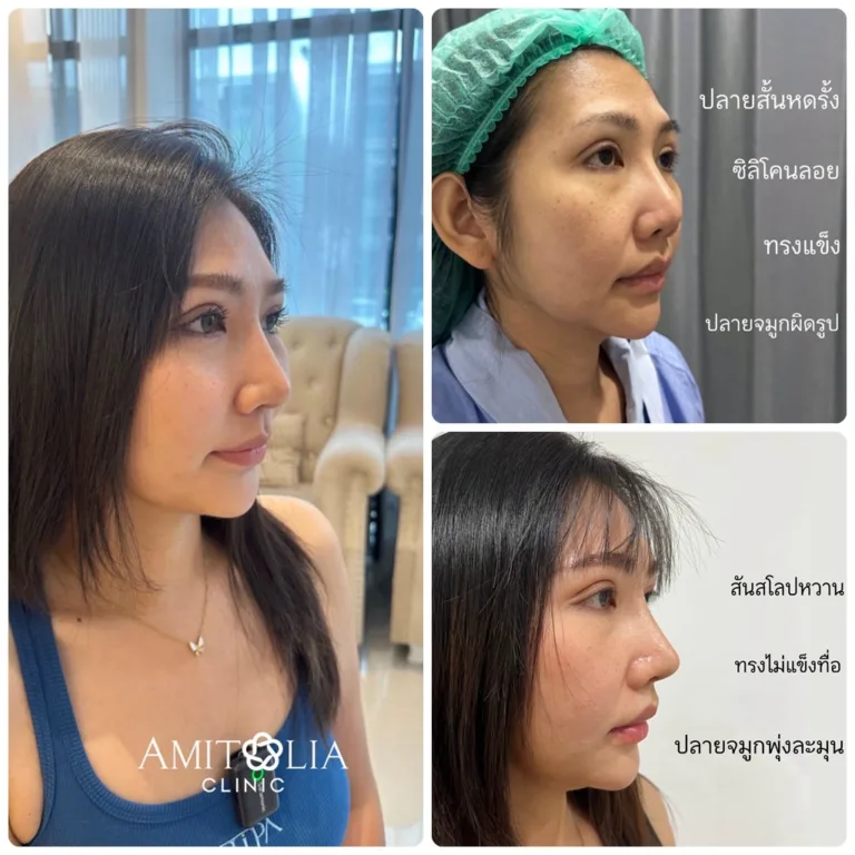 แก้จมูกใหม่